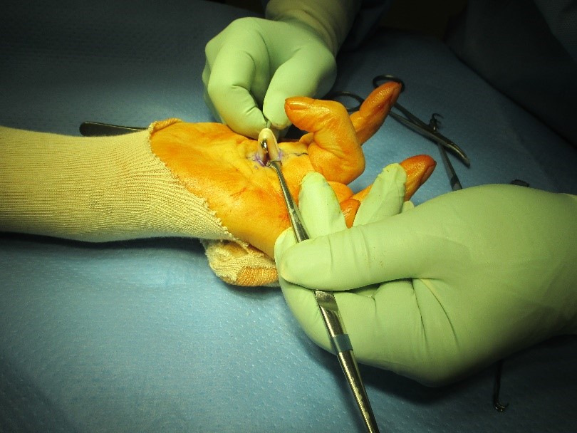 手術中の写真。屈筋腱を引き出して引っかかりを確認しています。