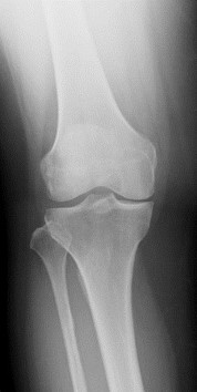 高位脛骨骨切り術でO脚を矯正した下肢レントゲン写真(術前)