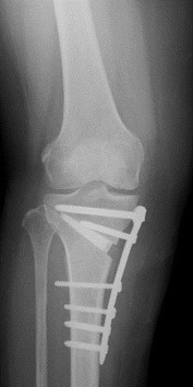 高位脛骨骨切り術でO脚を矯正した下肢レントゲン写真(術後)