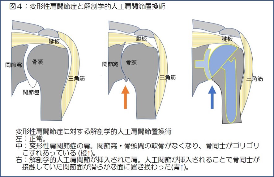 図4　変形性肩関節症と解剖学的人工肩関節置換術
