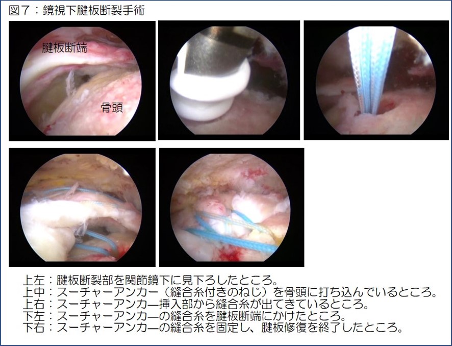 図7　鏡視下腱板断裂手術