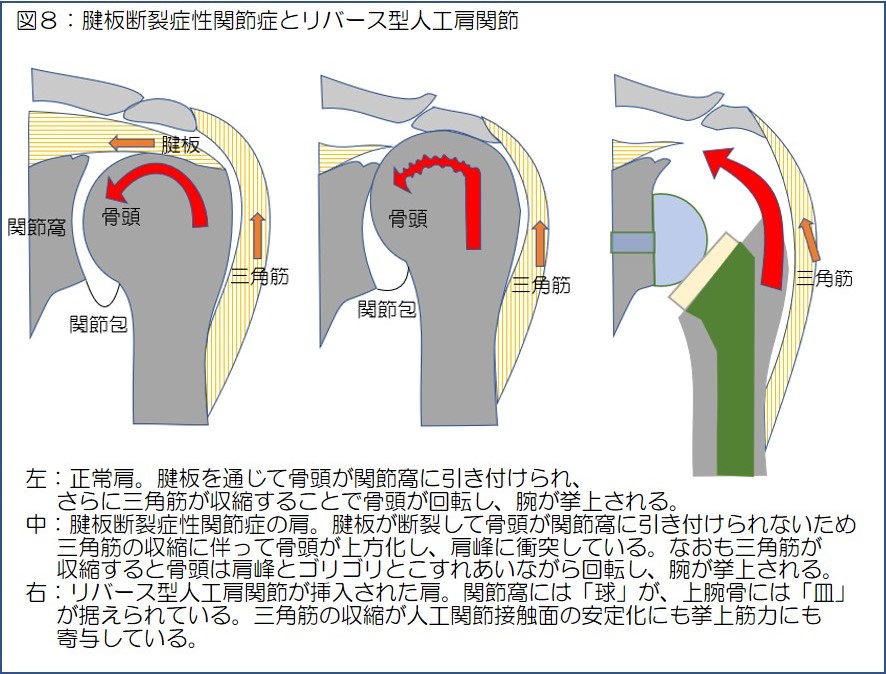 図8　腱板断裂症性関節症とリバース型人工肩関節