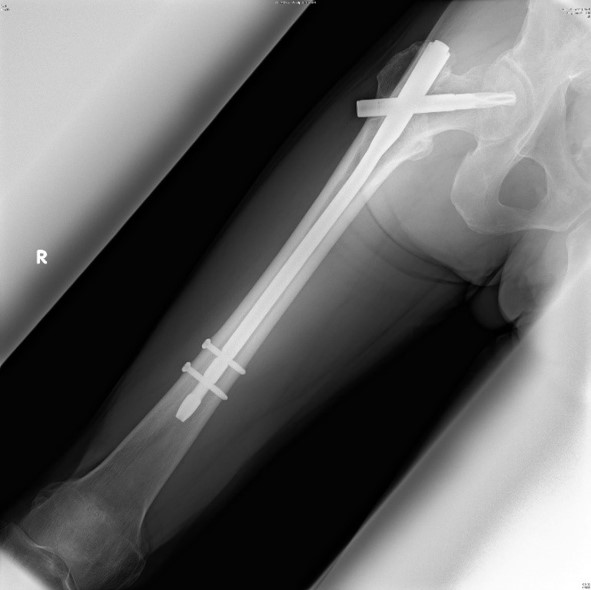 大腿骨転子部骨折に対する髄内釘固定 手術後