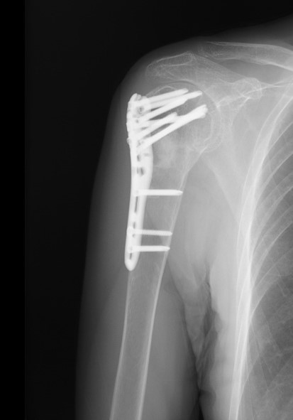上腕骨近位端骨折に対するプレート固定 手術後
