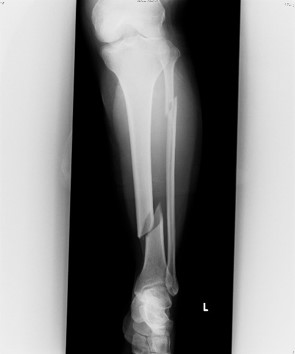 脛骨骨幹部骨折に対する髄内釘固定 手術前