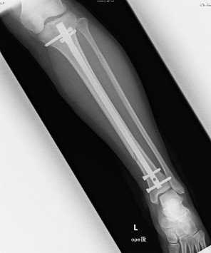 脛骨骨幹部骨折に対する髄内釘固定 手術後