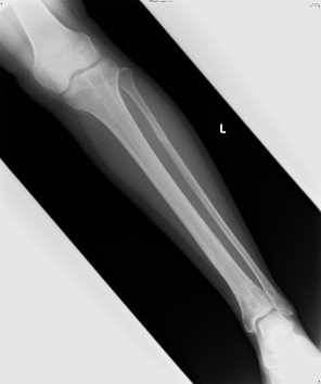 脛骨骨幹部骨折に対する髄内釘固定 金属を除去した治癒後
