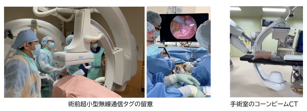 術前超小型無線通信タグの留置